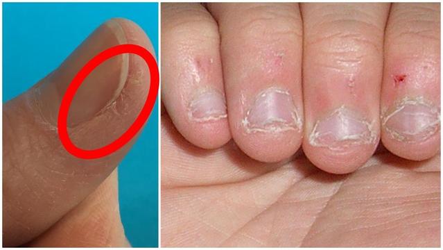 6 Dinge, die Du gegen eingerissene Fingerkuppen tun kannst