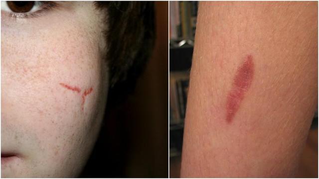 Der Pigmentfleck über der Lippe nach der Bräunung